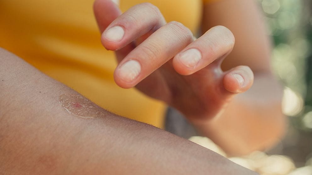 treatment burn or bite
